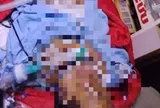 Bị bỏng nặng, mẹ đợi con thi xong tốt nghiệp THPT mới yên lòng nhắm mắt