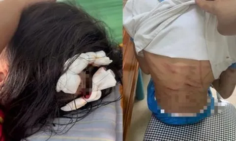 Bắt khẩn cấp cha dượng vụ bé gái lớp 5 bị đánh đập dã man