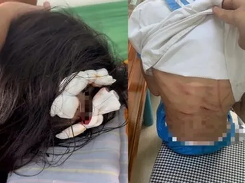 Bắt khẩn cấp cha dượng vụ bé gái lớp 5 bị đánh đập dã man